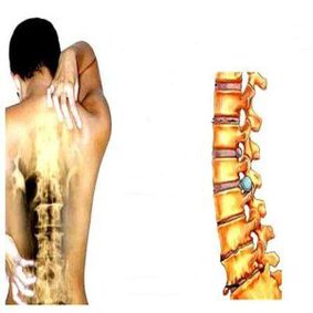 Stadi di osteocondrosi