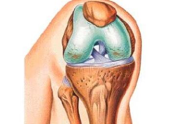 Le principali cause dell'osteoartrosi del ginocchio