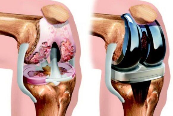 Prima e dopo l'endoprotetica dell'articolazione del ginocchio con osteoartrite