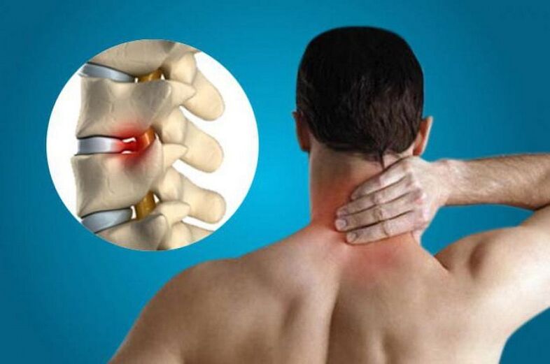 Danni alle vertebre cervicali dovuti all'osteocondrosi