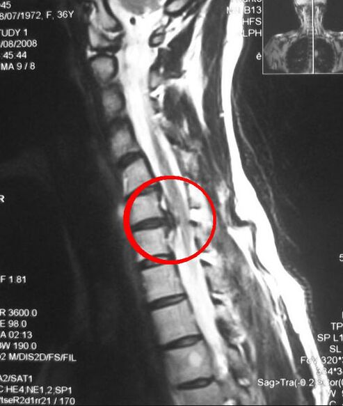 Sintomi dell'osteocondrosi toracica alla radiografia